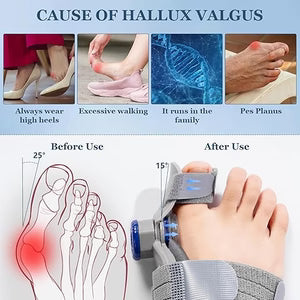 FeetifFix - Bunion Corrector